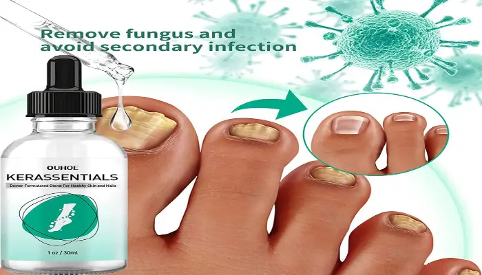 Kerassentials - Natural Oils for Nail Fungus and Skin Health